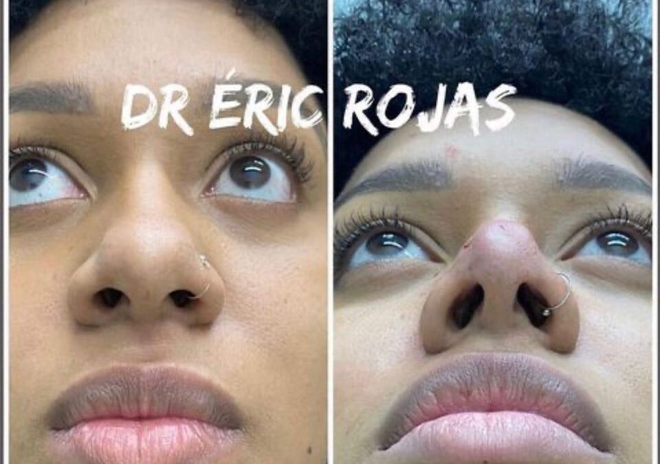 Afinamiento de punta de nariz