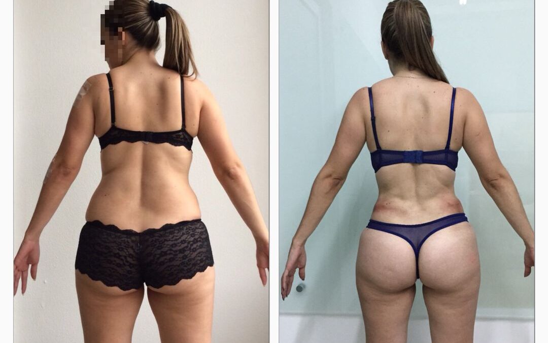 Resultado de procedimiento Slim Láser 8 días despues