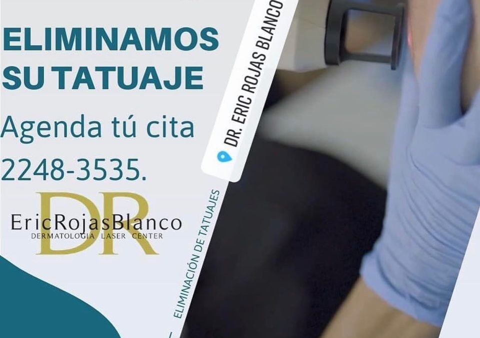La eliminación de tatuajes