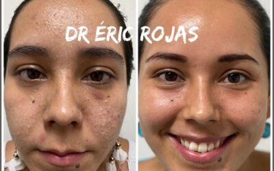 Ya no MÁS ACNÉ SOLO DEBES BUSCARME DR ÉRIC ROJAS