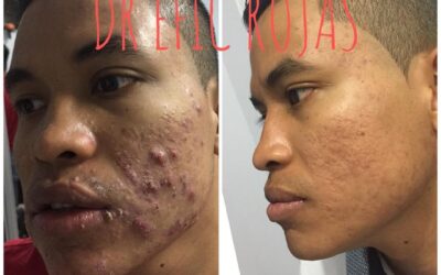 Acné YA NO MÁS DR ÉRIC ROJAS 22483535