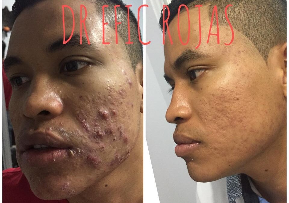 Acné YA NO MÁS DR ÉRIC ROJAS 22483535