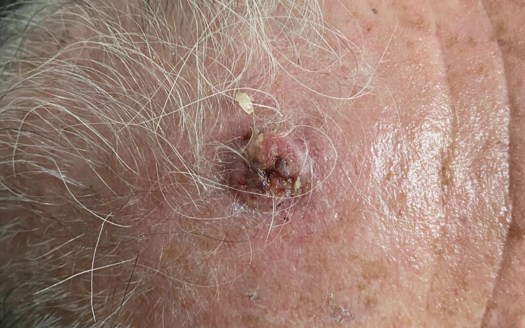 Cancer de PIEL CIRUGÍA DE ELIMINACIÓN Y COLGAJO