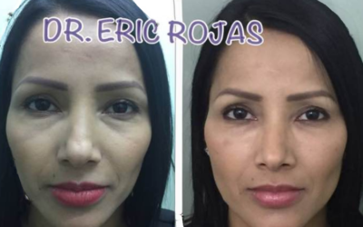 Transferencia Plaquetaria