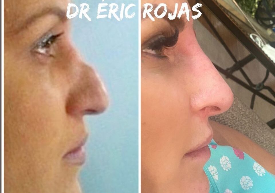 Reconstrucción de NARIZ DESPUÉS DE CIRUGÍA