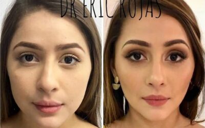 Perfilado facial