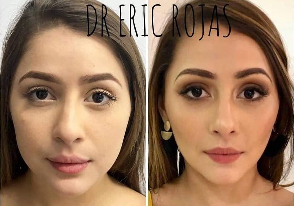 Perfilado facial