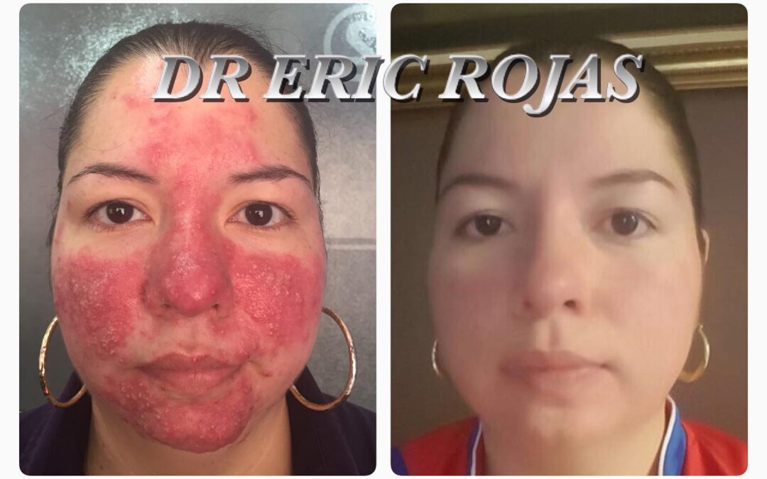 ROSÁCEA YA PUEDES ESTAR FELIZ EL DR ÉRIC ROJAS