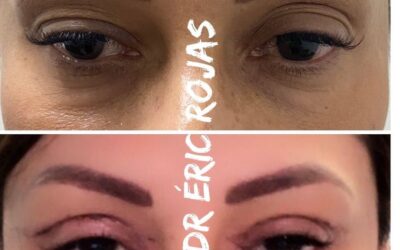 7 DÍAS DE DERMOBLEFAROPLASTIA DR ÉRIC ROJA