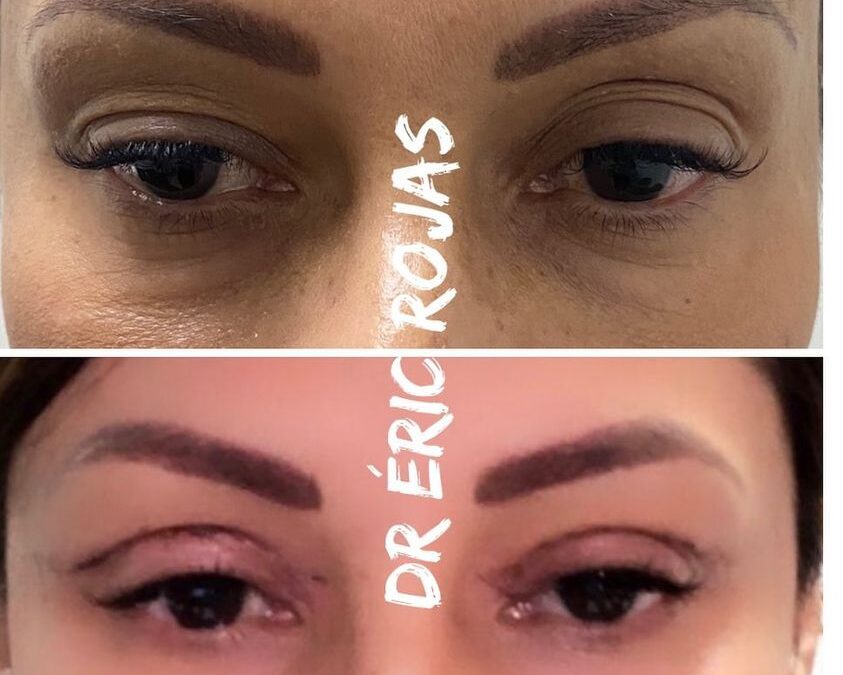 7 DÍAS DE DERMOBLEFAROPLASTIA DR ÉRIC ROJA