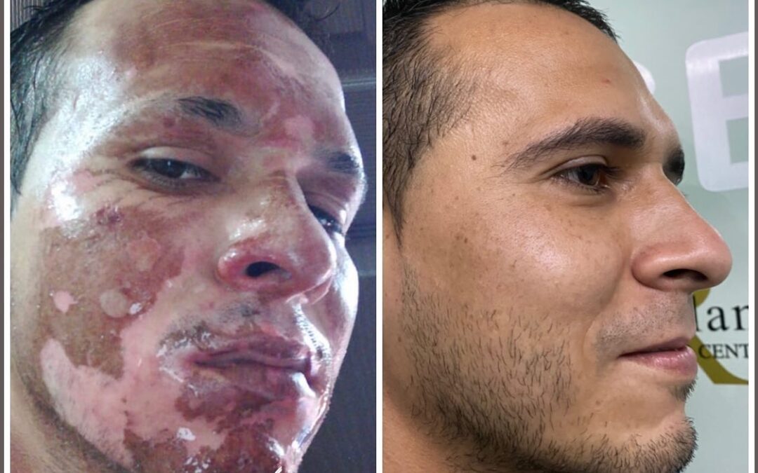 TRATAMIENTO DE PACIENTE QUEMAD