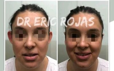 Otoplastía Dr Eric Rojas