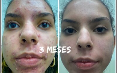 ACNÉ YA NO MÁS DR ÉRIC ROJAS 22483535