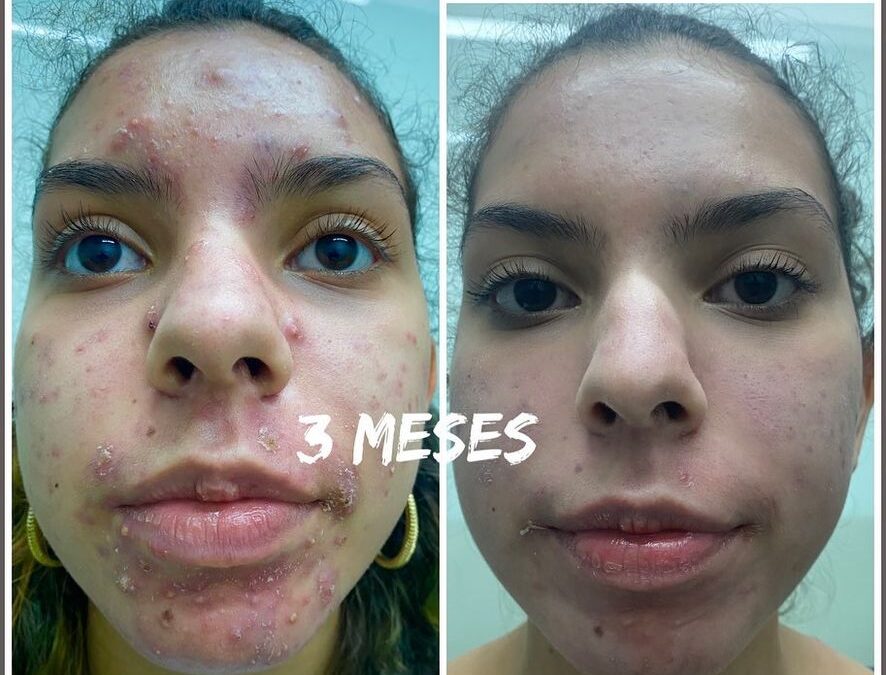 ACNÉ YA NO MÁS DR ÉRIC ROJAS 22483535