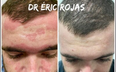 Dermatitis seborreica Severa