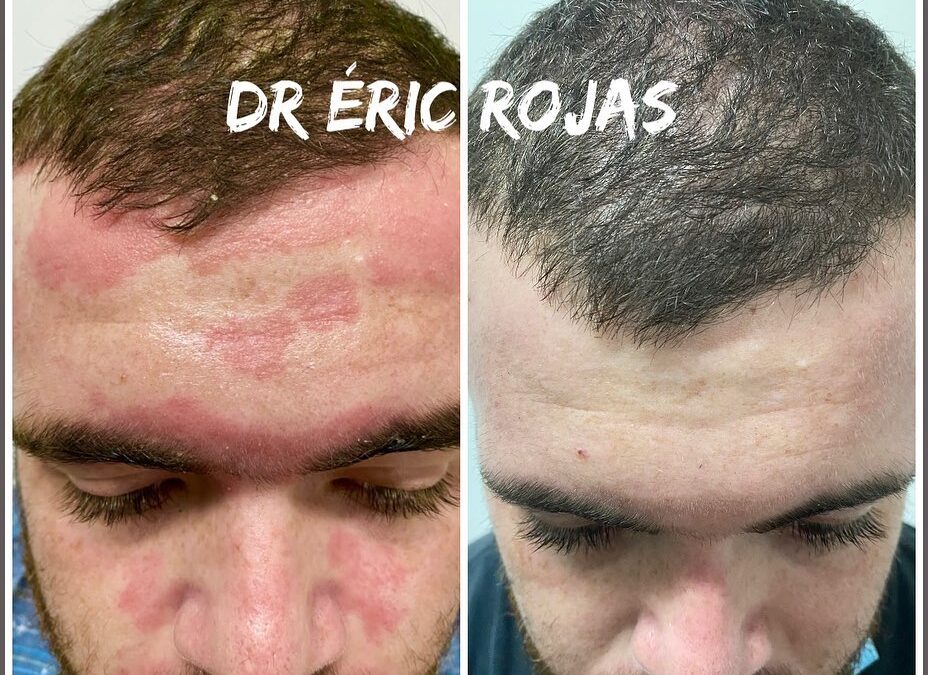 Dermatitis seborreica Severa