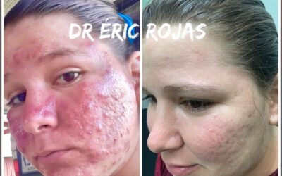 TIENES ROSÁCEA EL DR ÉRIC ROJAS TE PUEDE MEJORAR EL ROSTRO