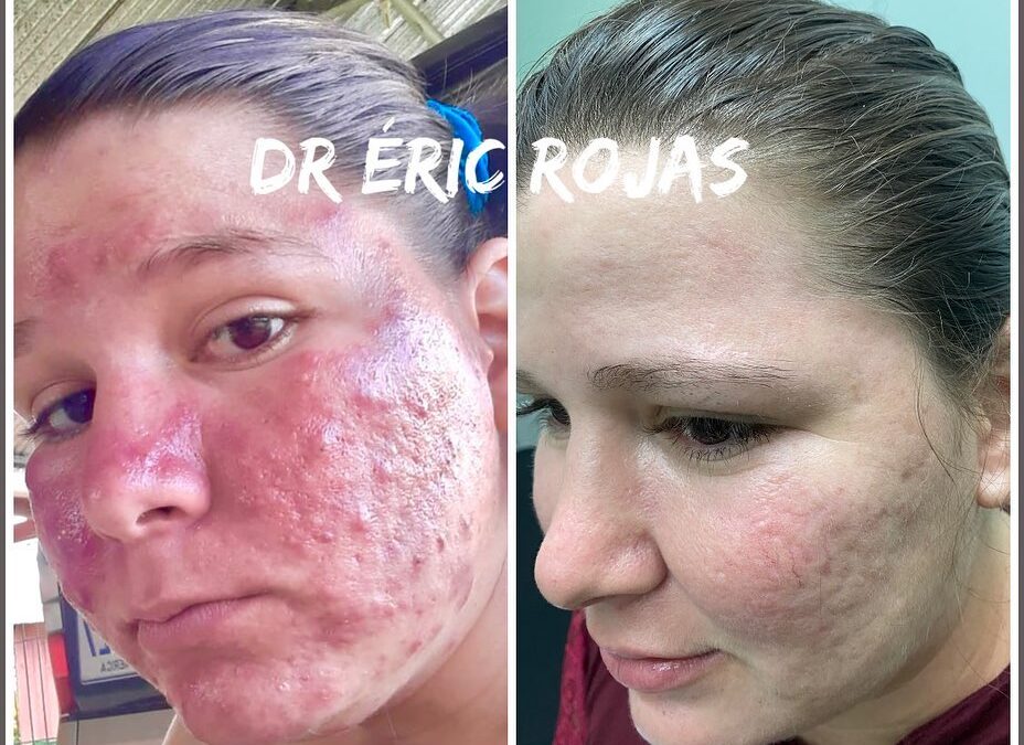 TIENES ROSÁCEA EL DR ÉRIC ROJAS TE PUEDE MEJORAR EL ROSTRO
