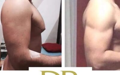 Slim láser con excelentes resultados