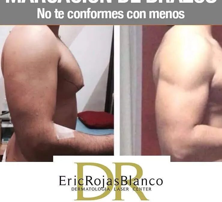 Slim láser con excelentes resultados