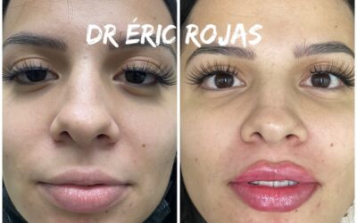 MODELADO DE LABIOS