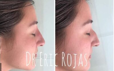 Perfilado de nariz