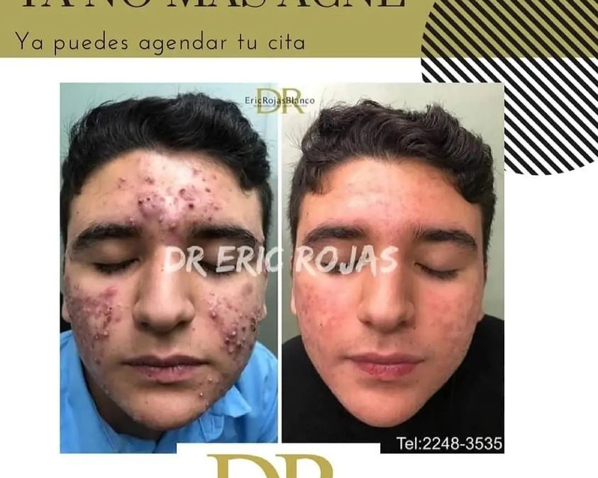 Tenemos la solución para el acné