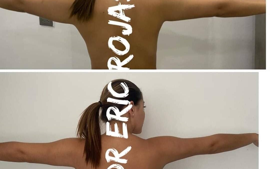 Slim láser de brazos