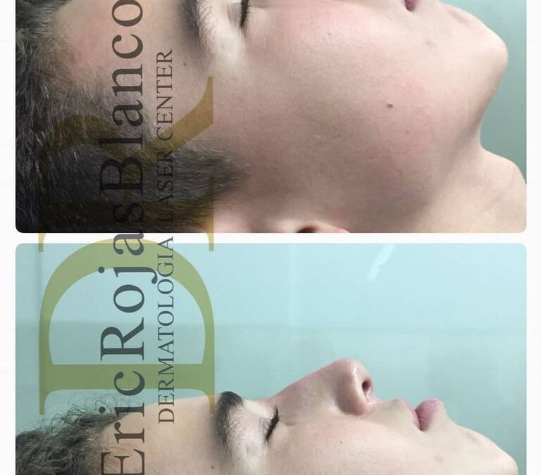 Excelentes resultados en manos del Dr Eric Rojas