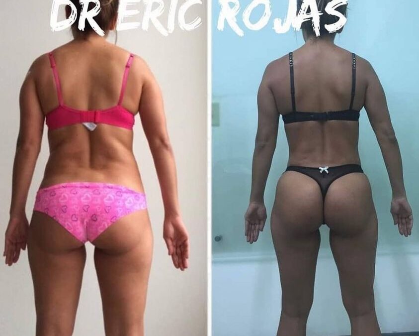 Slim láser Dr Eric Rojas.