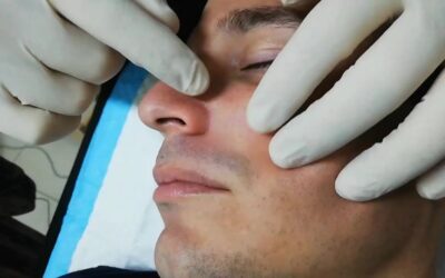 Un pilomatrixoma es un bulto duro…