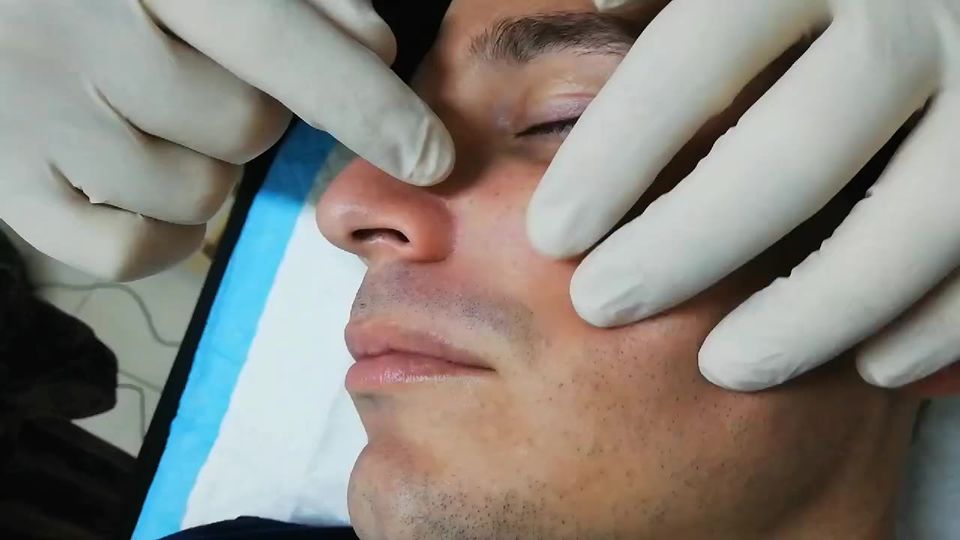 Un pilomatrixoma es un bulto duro…