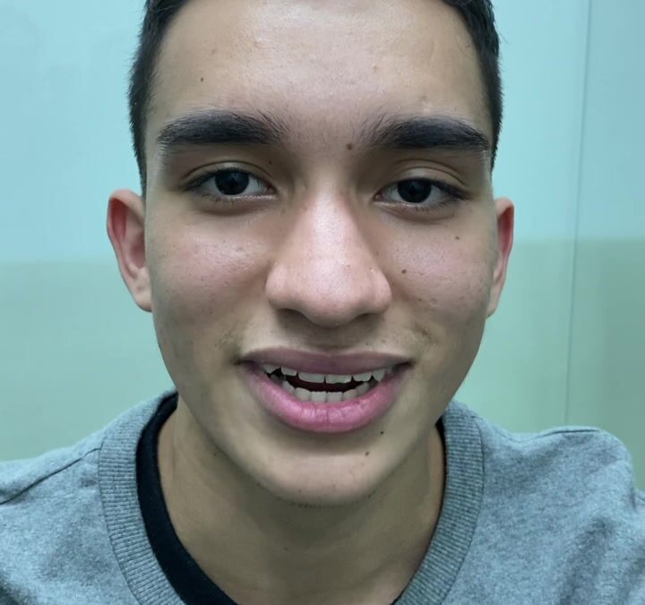 Caras libres de acné