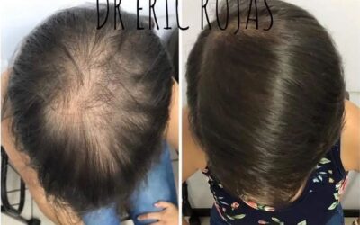 Podemos ayudarle a recuperar su cabello