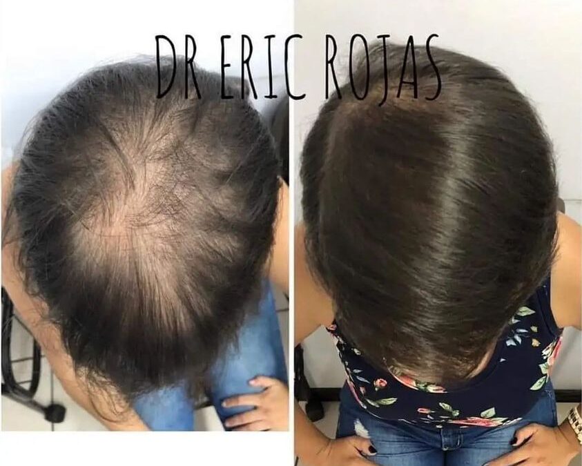 Podemos ayudarle a recuperar su cabello