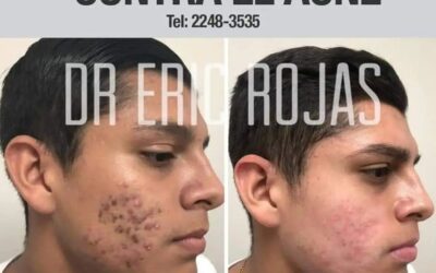 Tratamiento contra el acné