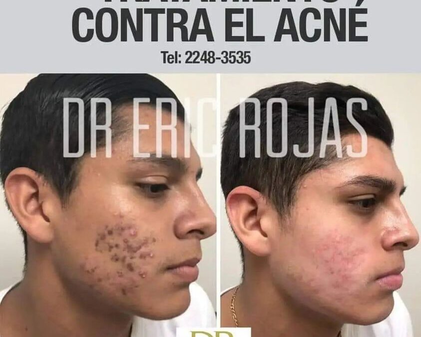 Tratamiento contra el acné