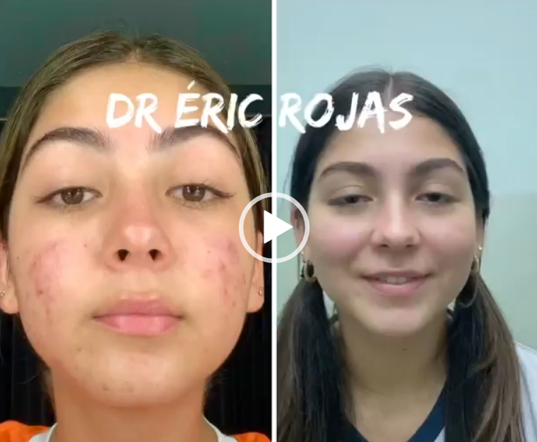 ACNÉ YA NO MÁS DR ÉRIC ROJAS 22483535