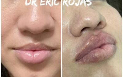 Modelado de LABIOS DR ÉRIC ROJAS en oferta solo por $400 dólares