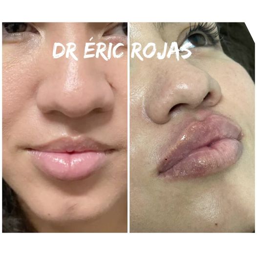 Modelado de LABIOS DR ÉRIC ROJAS en oferta solo por $400 dólares