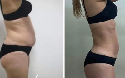 Resultados Slim Láser