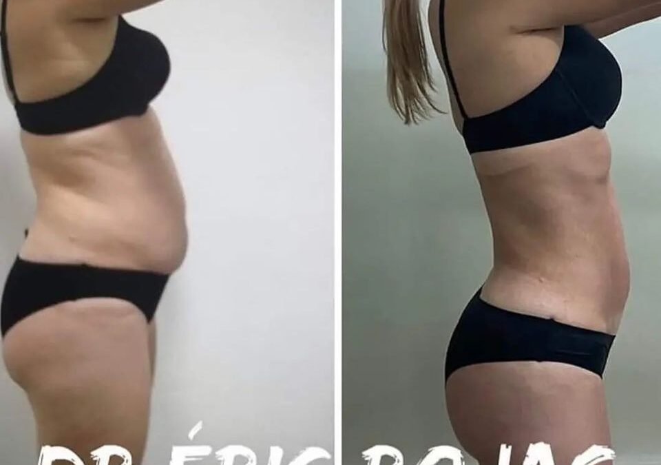 Resultados Slim Láser