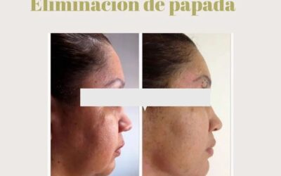Eliminación de papada Dr. Eric Rojas