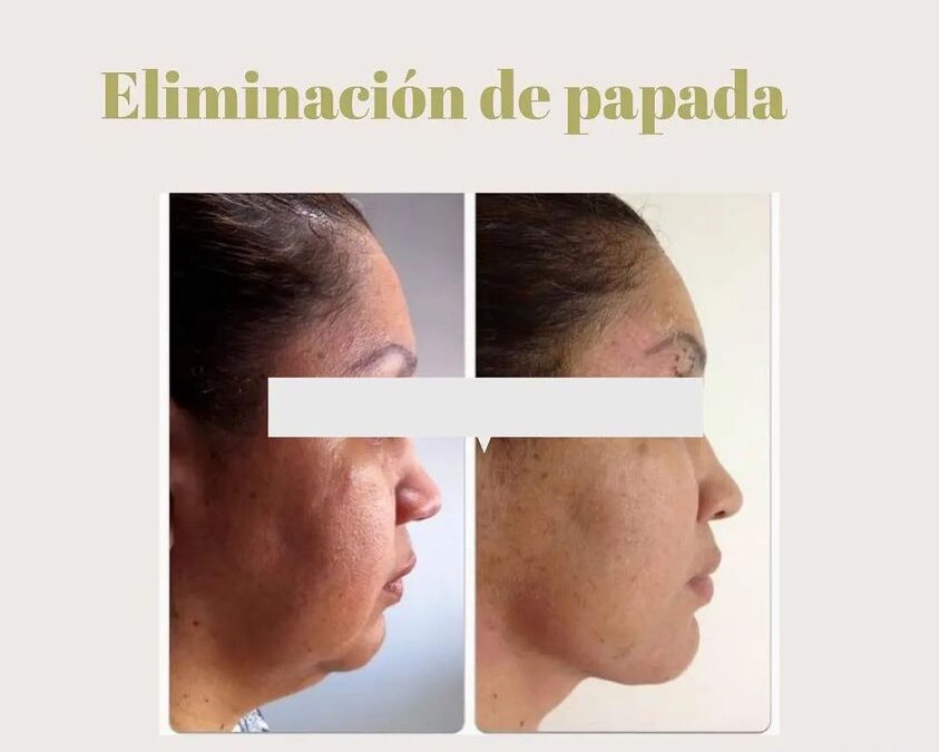 Eliminación de papada Dr. Eric Rojas