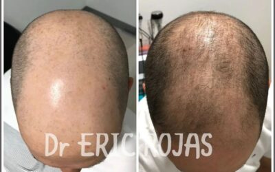 Recupere su cabello en manos del Dr Eric Rojas