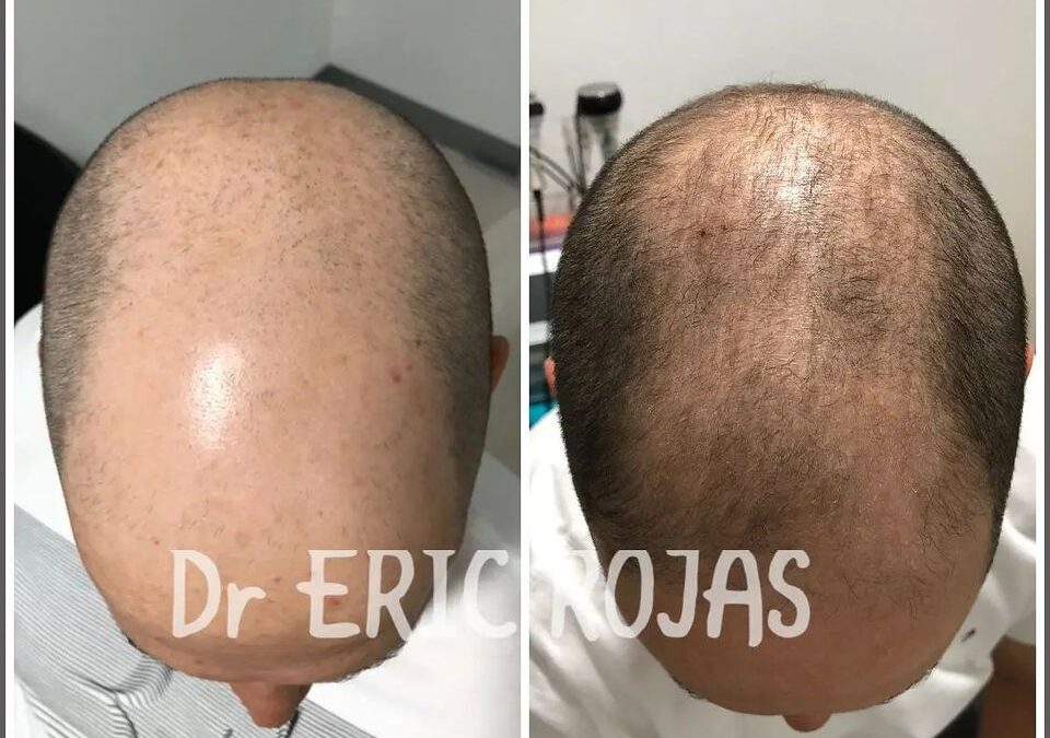 Recupere su cabello en manos del Dr Eric Rojas