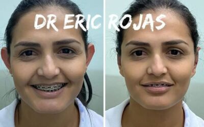 Otoplastía