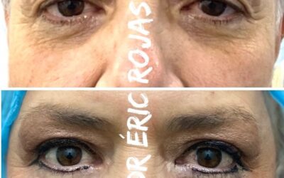 Dermoblafaroplastia y rejuvenecimiento
