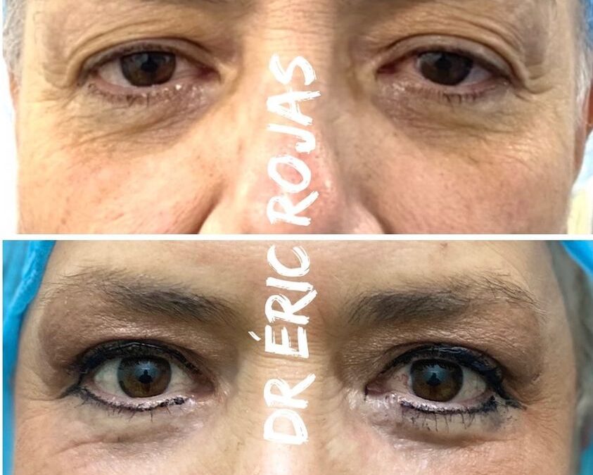 Dermoblafaroplastia y rejuvenecimiento