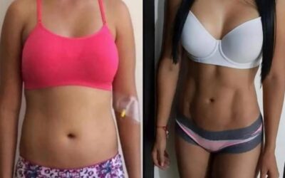 Resultados Slim Láser